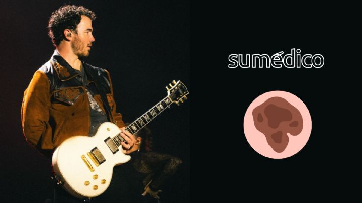 ¿Qué es el melanoma como el que le detectaron a Kevin Jonas?