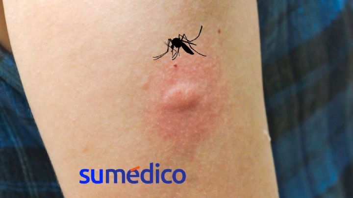 ¿Por qué los mosquitos te pican más a ti que a otras personas?