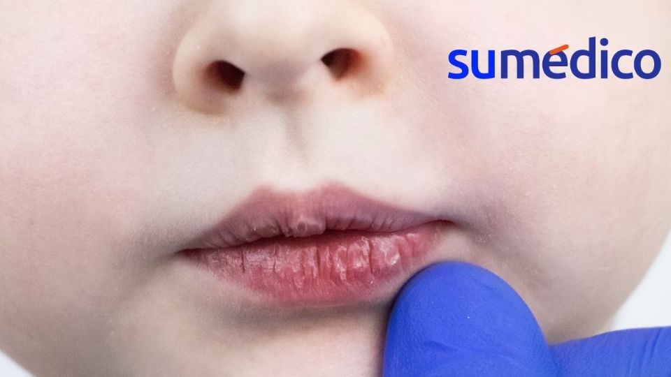 Así puedes actuar contra los labios secos en niñas y niños.