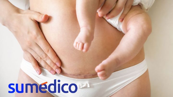 ¿Qué hacer para cuidar la piel después del parto?
