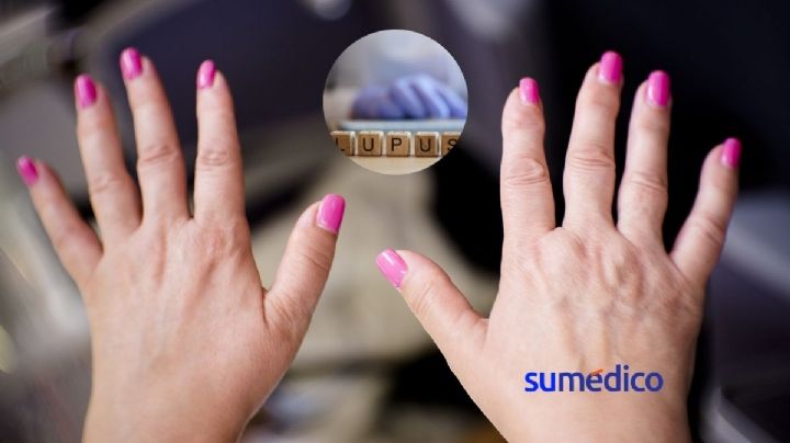 ¿Cuál es la causa del lupus?