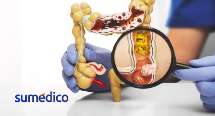 Divertículos en el colon a partir de los 50 ¿Qué síntomas da?