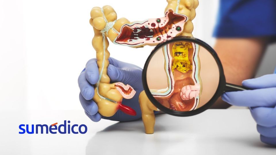 Conoce sobre los divertículos en el colon y cómo atenderlos.