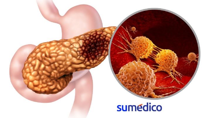 ¿Adiós al cáncer de páncreas? Estudio muestra resultados prometedores