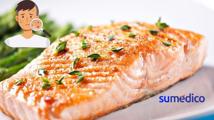 ¿Tienes acné? Comer salmón podría ayudarte