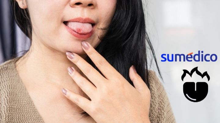 ¿Cómo curar la lengua quemada de manera rápida? 5 remedios caseros