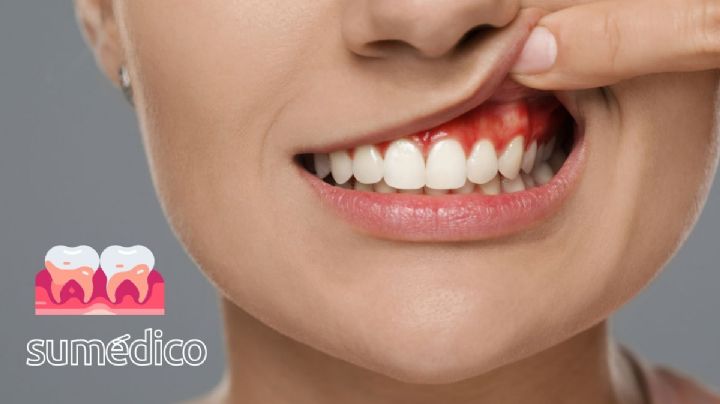 ¿Puedo contagiarme de gingivitis si mi pareja tiene esta enfermedad?