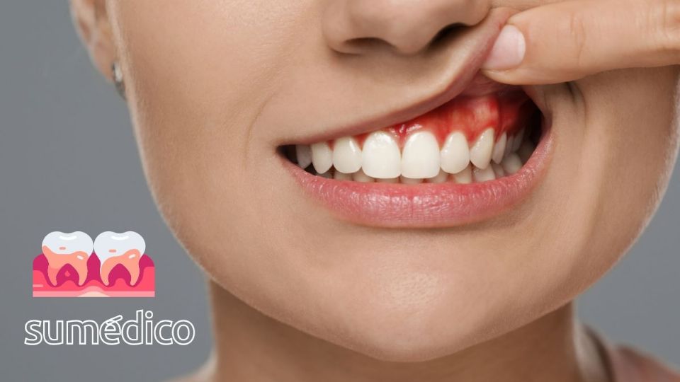 Conoce sobre la gingivitis y cómo prevenir un contagio.