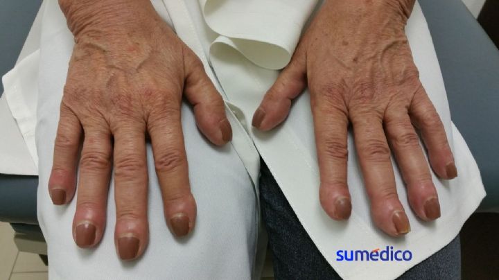 ¿Te pintas mucho las uñas? Aprende a detectar el cáncer en esta zona