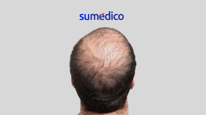 ¿Te queda poco pelo? Descubre cómo cuidarlo