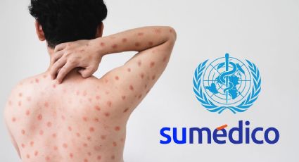 ¿Por qué la OMS analiza declarar el virus Mpox emergencia mundial?