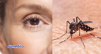 ¿Cómo afecta el dengue en los ojos?