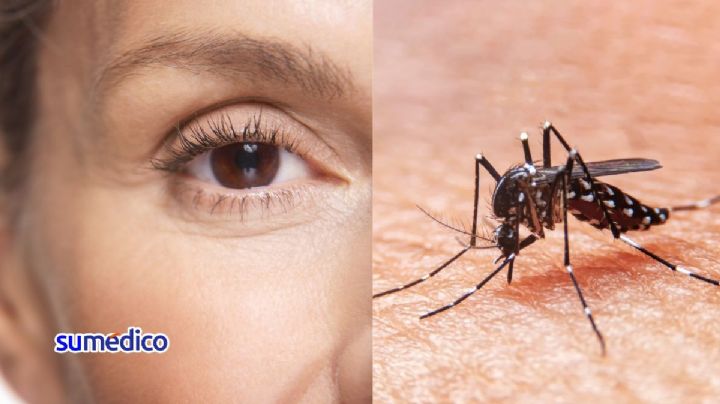 ¿Cómo afecta el dengue en los ojos?