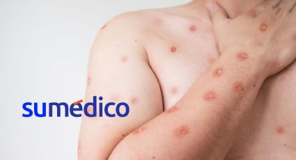 Los estados de México donde se han registrado casos de Mpox