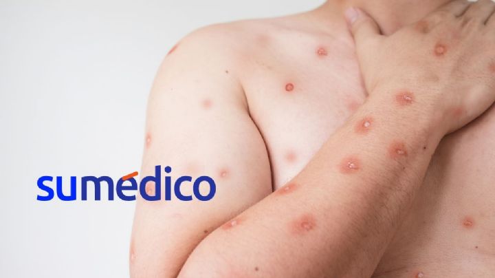 Los estados de México donde se han registrado casos de Mpox
