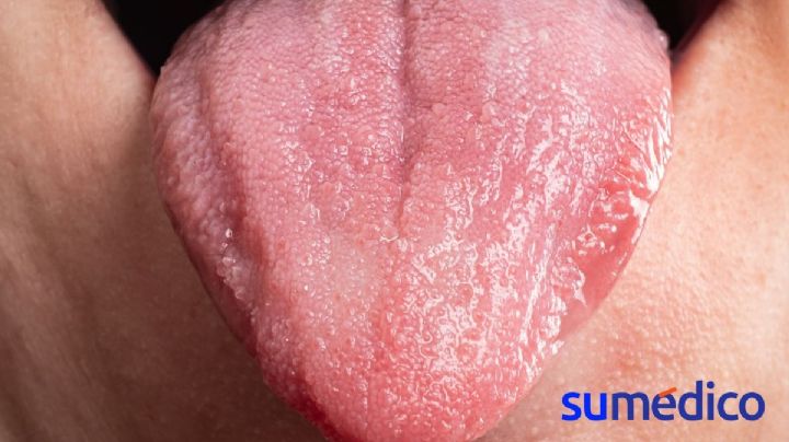 ¿Tienes manchas en tu lengua? Conoce sobre la lengua geográfica