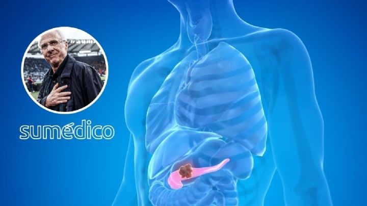 ¿Cómo afecta el cáncer de páncreas, enfermedad que padeció Sven-Göran Eriksson?