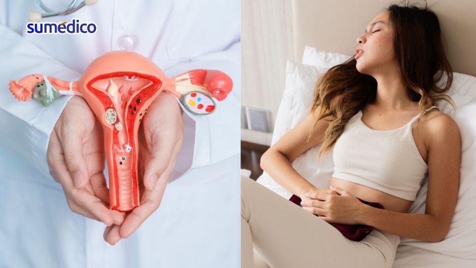 El diagnóstico de endometriosis puede retrasarse varios años porque se normalizan los síntomas.