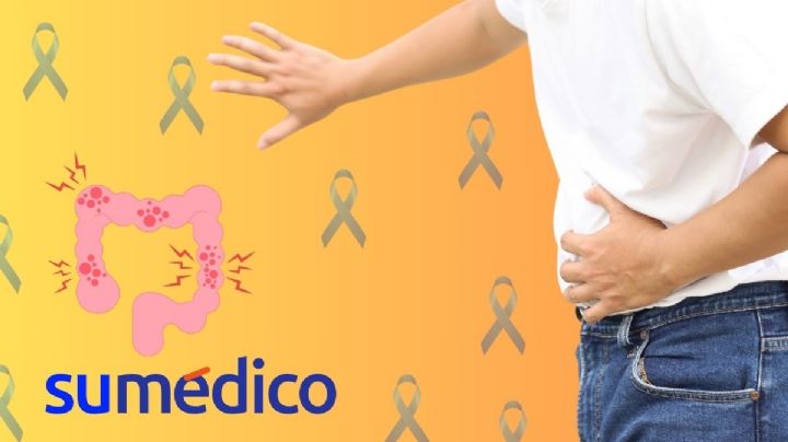 ¿Qué es el cáncer de colon y por qué afecta más a jóvenes?