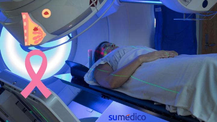 Efectos de la radioterapia en el cáncer de mama