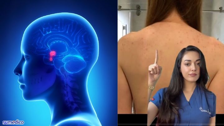 Un brote de acné podría ser un signo de este tipo raro de cáncer, según especialista