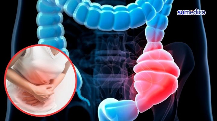 ¿Qué síntomas da el cáncer de colon? 5 señales que NO debes ignorar