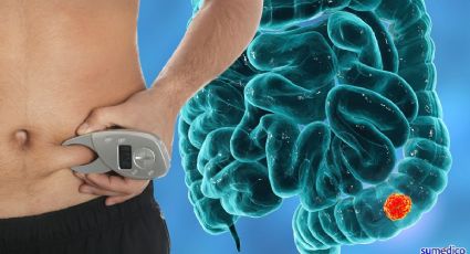 ¿Tienes grasa en estas zonas del cuerpo? Podrías tener más riesgo de cáncer de colon