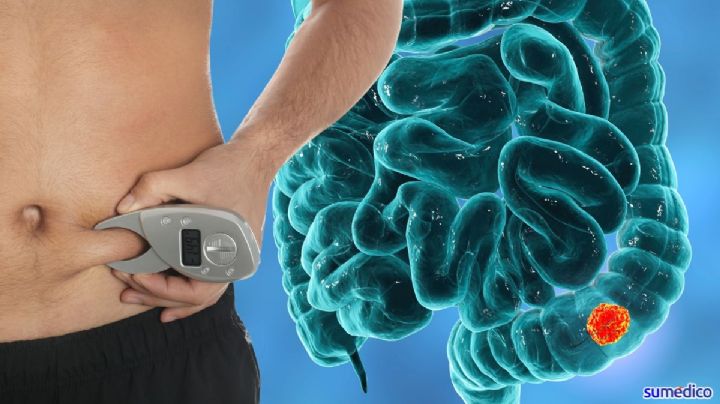 ¿Tienes grasa en estas zonas del cuerpo? Podrías tener más riesgo de cáncer de colon