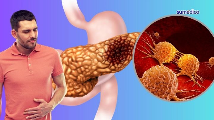 ¿Qué síntomas da el cáncer de páncreas? 5 señales que NO debes ignorar