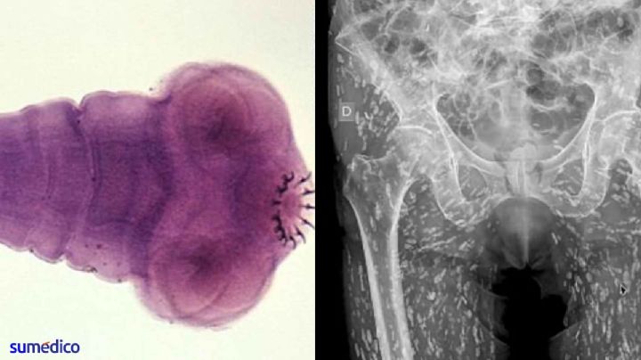 Radiografía reveló aterradoras criaturas en el cuerpo de un hombre; cometió este error en la cocina