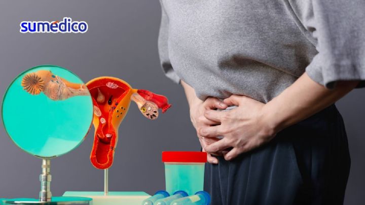 ¿Qué síntomas da el cáncer de ovario? 5 señales que NO debes ignorar