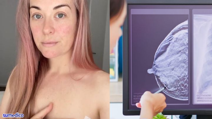 'Tuve síntomas por años y me dijeron que era eccema, resultó ser cáncer de mama'
