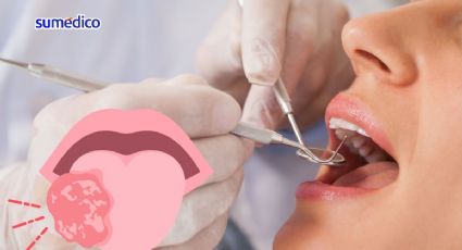 ¿Qué síntomas da el cáncer de lengua? 5 señales que NO debes ignorar