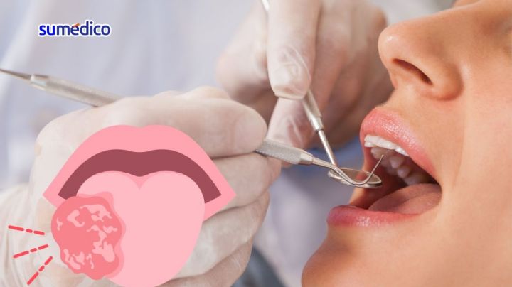 ¿Qué síntomas da el cáncer de lengua? 5 señales que NO debes ignorar