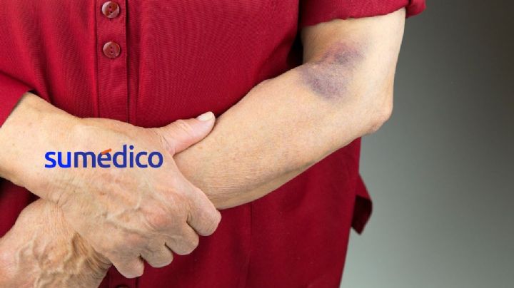 ¿Qué significa que los adultos mayores tengan moretones de la nada?