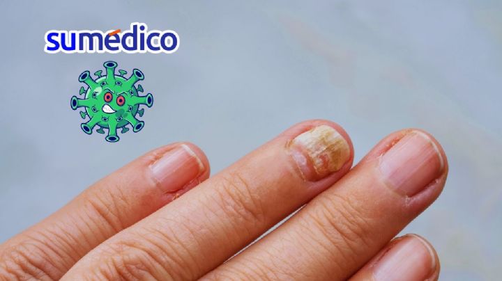 ¿Qué enfermedades se detectan a través de las uñas?