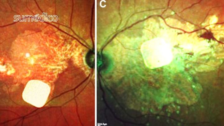 Nueva prótesis ocular permite leer a las personas con ceguera irreversible