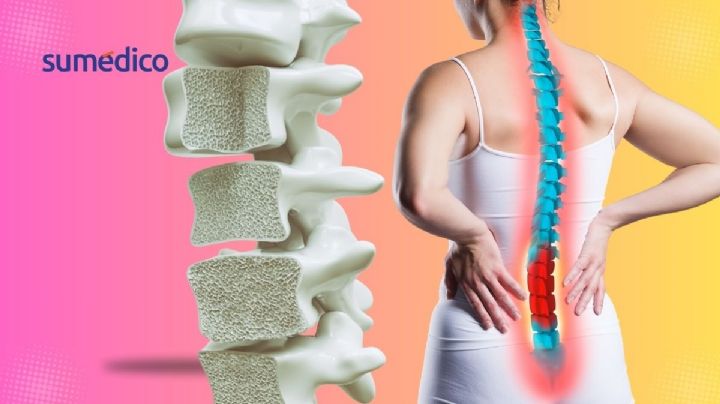 5 Consejos para prevenir la osteoporosis en la vejez, según los expertos