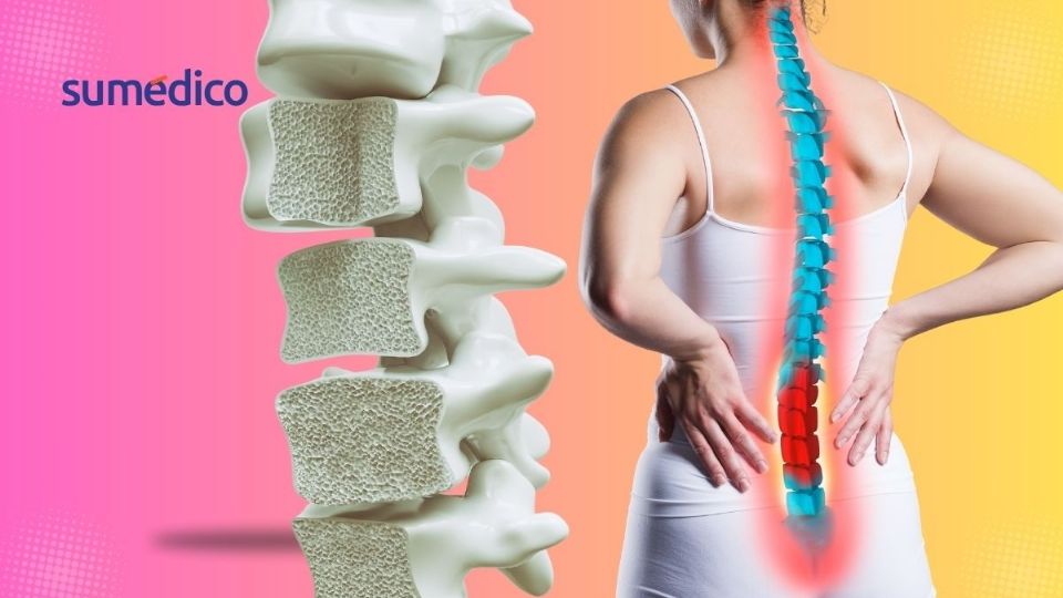 La osteoporosis afecta los huesos