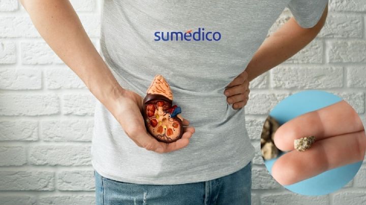 ¿Sabes qué son las piedras en los riñones? Esto es todo lo que debes conocer