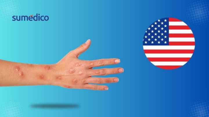 Viruela del mono: ¡Alerta en Estados Unidos por casos de nueva cepa en California!
