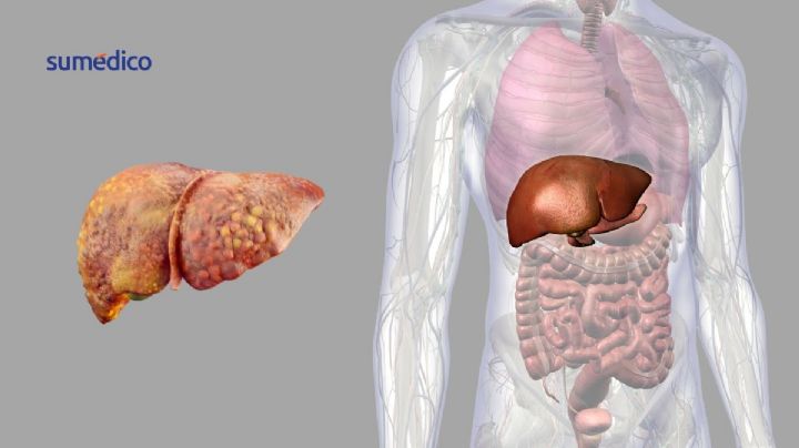Identifican proteína clave en la progresión del hígado graso