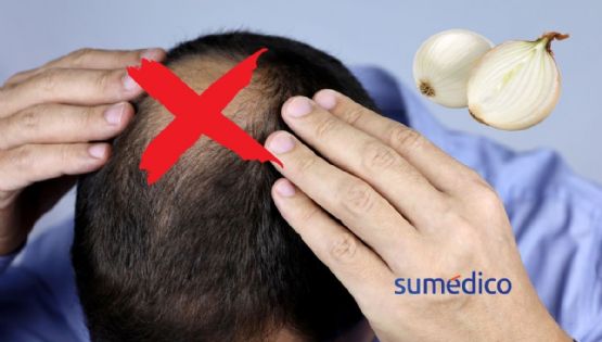 ¿Adiós a la calvicie gracias a la cebolla? Un estudio encontró sorprendente hallazgo