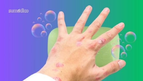 ¿Cómo aliviar la psoriasis? Algunos productos recomendados por dermatólogos