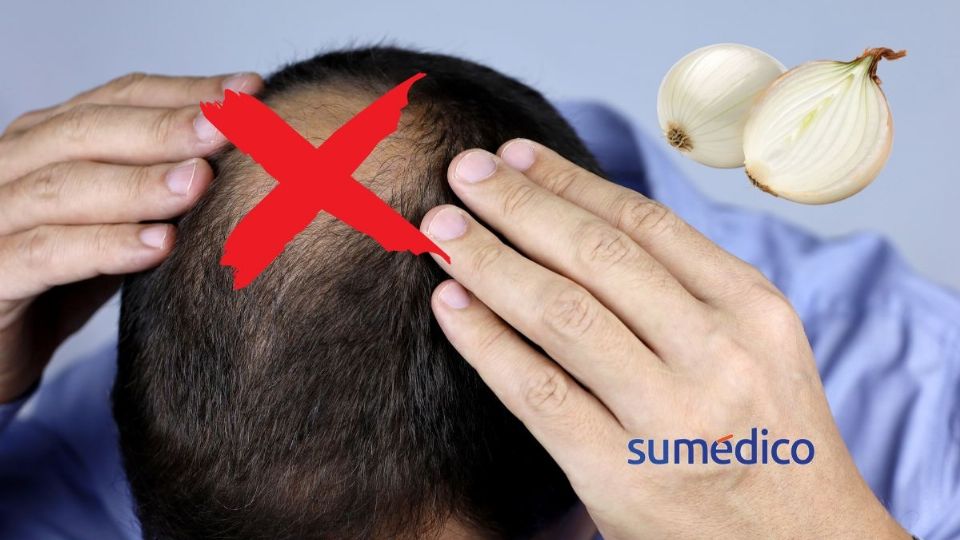 Descubre si la calvicie puede revertirse gracias a la cebolla