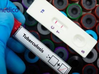 Donald Trump corta fondos y la tuberculosis vuelve a amenazar al mundo