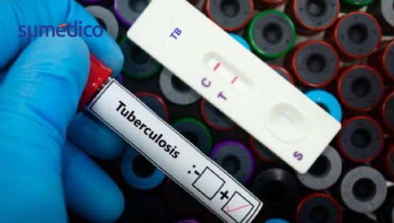 Donald Trump corta fondos y la tuberculosis vuelve a amenazar al mundo