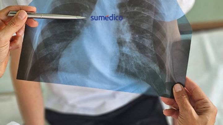 Tuberculosis avanza en México: especialistas alertan por auge de casos