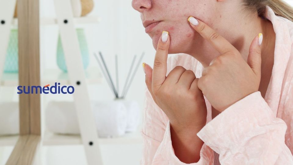 El acné en la edad adulta es un problema habitual