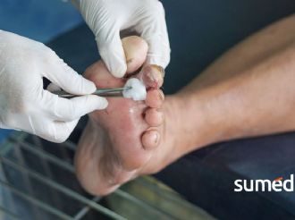 Guía de cuidado del pie diabético: prevención